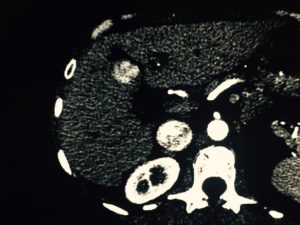 mri cancer spot on liver karen ihlelpc